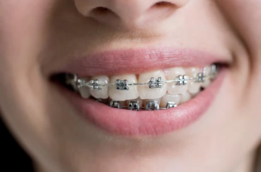 Dental Braces