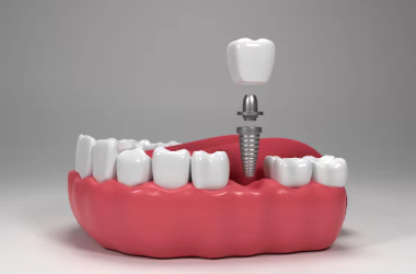 Dental Implants