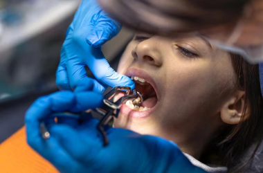 Wisdom Teeth Extraction